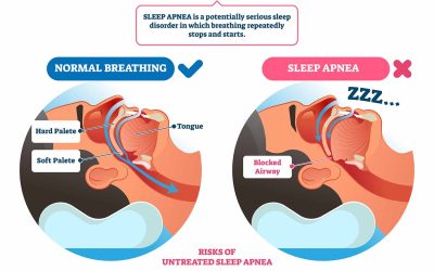 Understanding Sleep Apnea: Symptoms, Causes, and Risk Factors