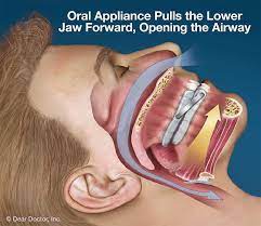 oral appliance threapy for sleep apnea
