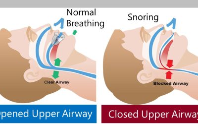 What Causes Snoring?