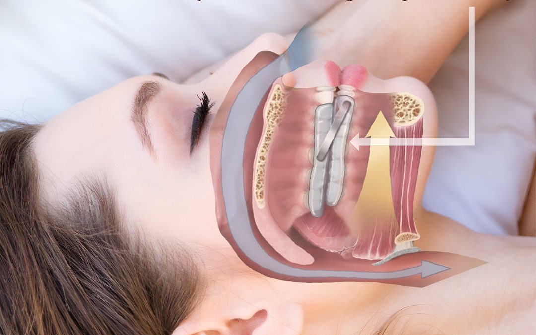 Oral appliance therapy for sleep apnea