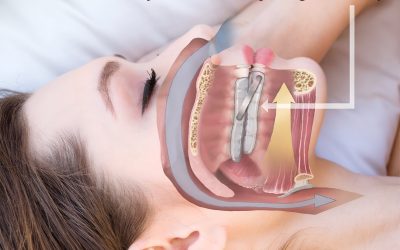Exploring the Benefits of Oral Appliance Therapy for Sleep Apnea